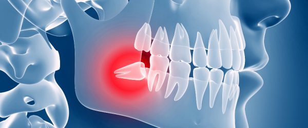 Chirurgia odontoiatrica - Estrazioni dentarie | Quartu S. Elena